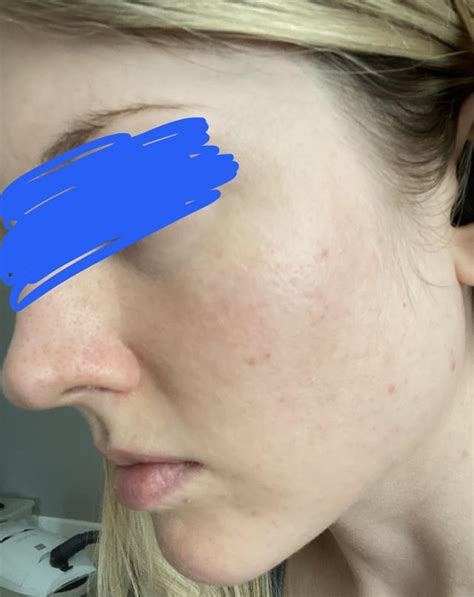 None of them worked for redness except briamodinine which was temporary. . Azelaic acid with soolantra reddit